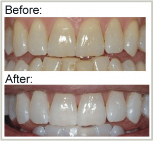 Teeth Whitening