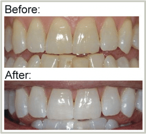 Teeth Whitening